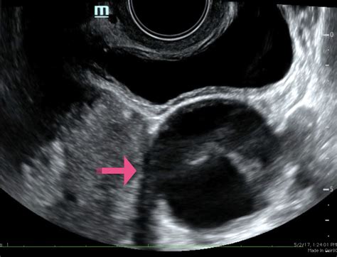 ovarian tube torsion ultrasound